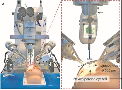 治疗严重眼疾有了新路径：借助机器人与人工智能，最精细的眼科手术已可实现部分自动化