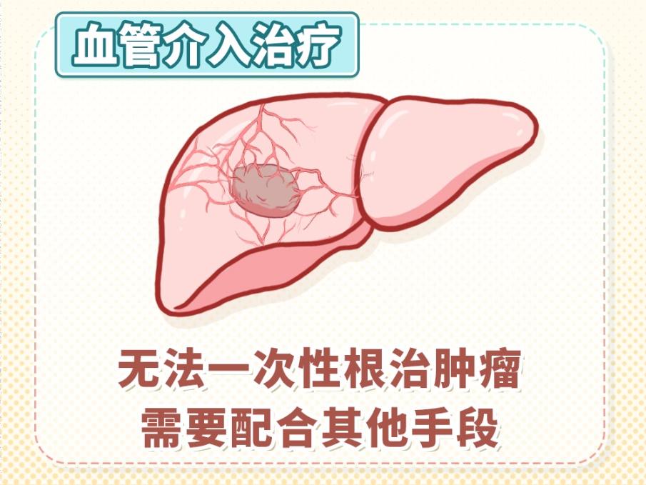 肝癌不用开大刀，微创介入疗法如何精准“狙击”肿瘤？
