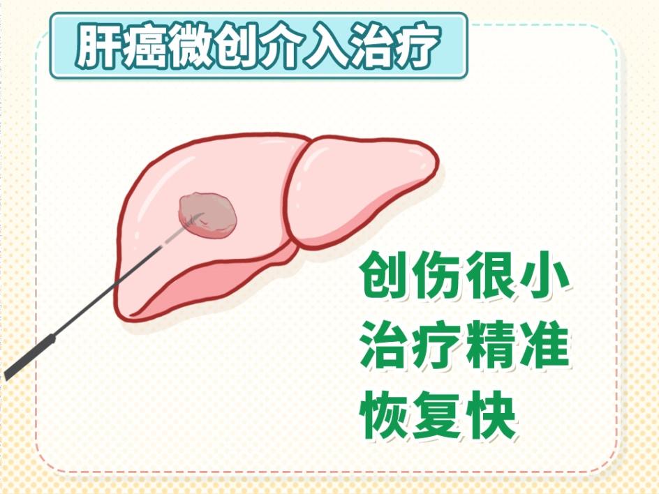 肝癌治疗方法有哪些？只能“一刀切”吗？
