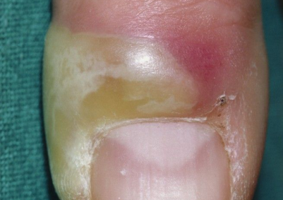 指甲为什么总从这个地方断开 是缺钙了吗