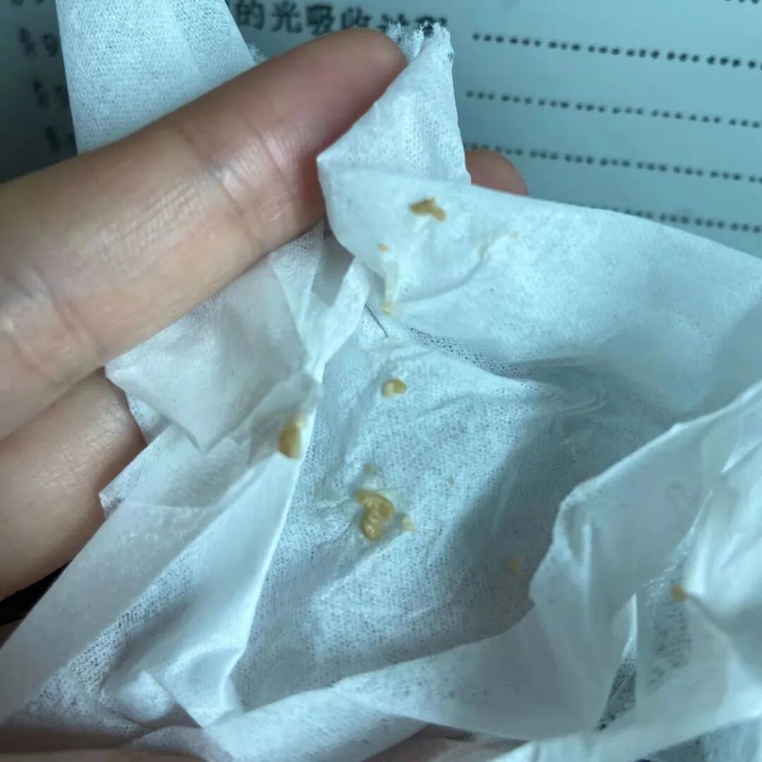 吐出臭臭的黄色颗粒,这是我吃进去的玉米和椰子吗?