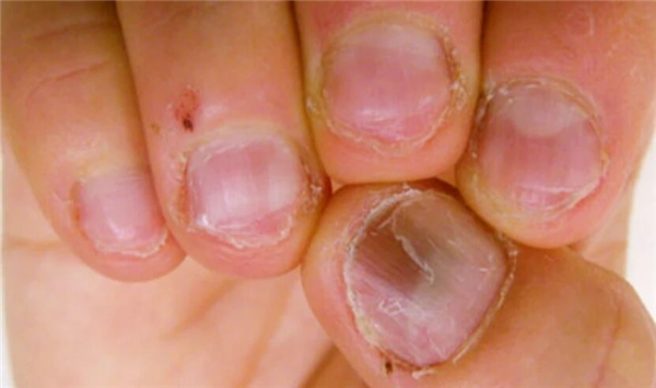 指甲为什么总从这个地方断开 是缺钙了吗