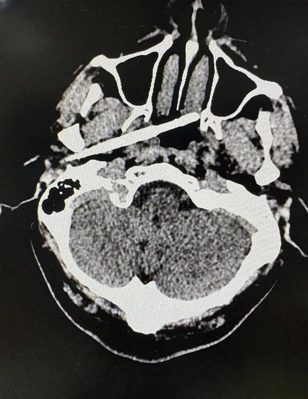 距动脉仅5毫米！男子被一根筷子从耳部插入颅底：医生成功救回