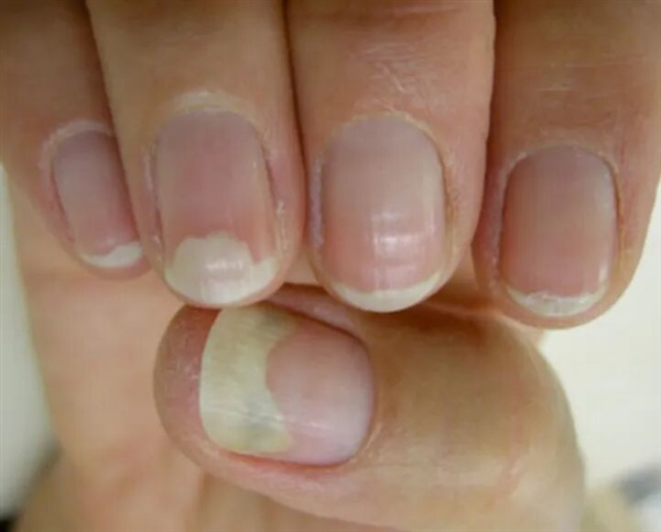 指甲为什么总从这个地方断开 是缺钙了吗