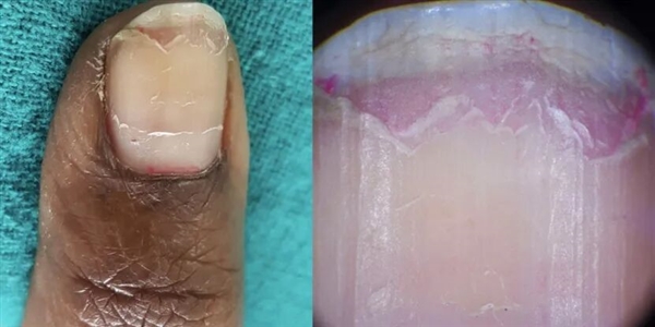 指甲为什么总从这个地方断开 是缺钙了吗