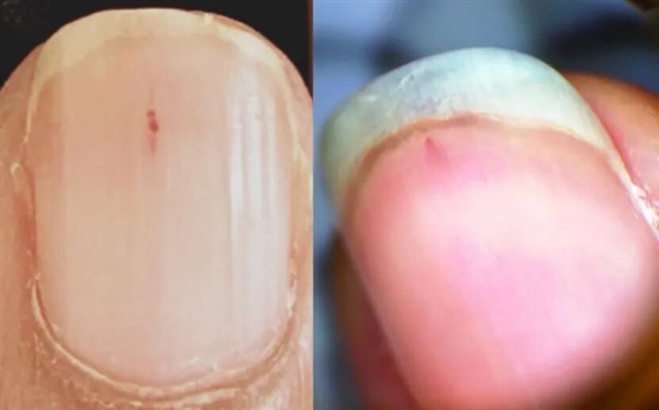 指甲为什么总从这个地方断开 是缺钙了吗