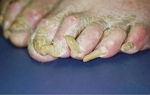 指甲为什么总从这个地方断开 是缺钙了吗