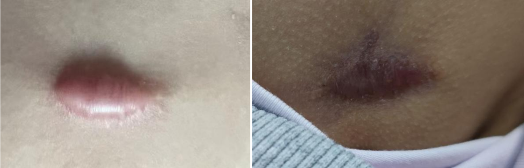 别让一道疤，成了孩子心里的刺