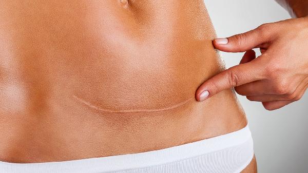 剖腹产后肚子里面有硬块正常吗