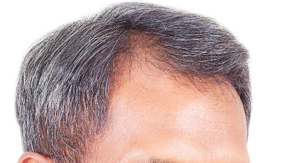 白头发多是缺什么维生素男的吗