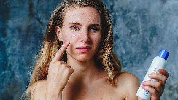 30岁还会长青春痘吗