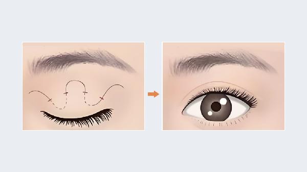 6类人群适合做埋线双眼皮