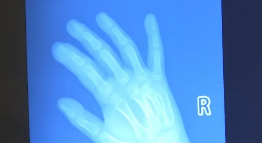 湖南5岁男童啃手致重度感染侵骨 医生：警惕诱发脓毒血症