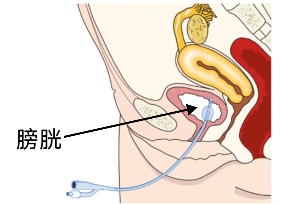 科普｜手术后，为何要插入导尿管？有什么作用？