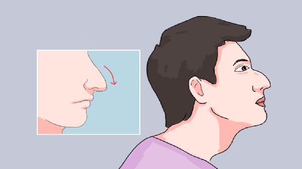 鹰钩鼻矫正手术的四种方法