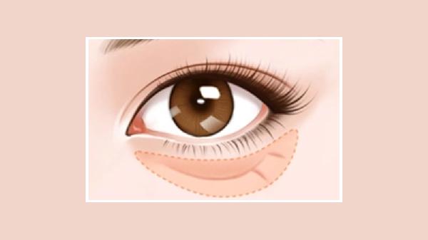 杭州祛眼袋的优势